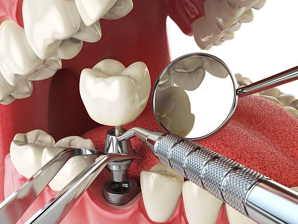 Best Emergency Treatment for Toothache in Roseburg Nth, OR